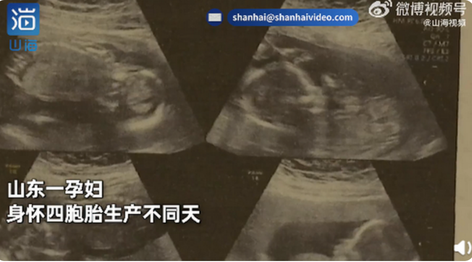 罕见！山东一孕妇身怀四胞胎生产不同天，网友：望平安！